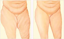 Thigh lift before and after with incision location