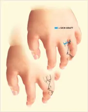 Hand showing birth deformity grafts and incisions