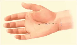 Hand showing carpal tunnel relief incisions