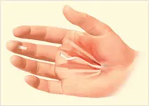 Hand showing trauma repair incision