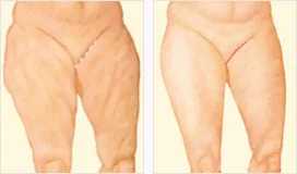 Medial thigh lift before and after with incision location