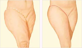 Outer thigh lift before and after with incision location