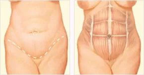 Diagram showing tummy tuck incisions and abdominal muscles