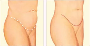 Tummy Tuck before and after with incision