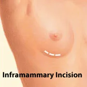 Breast augmentation inframammary incision location