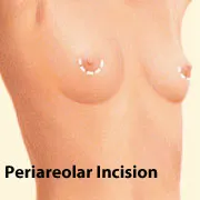 Breast augmentation periareolar incision location