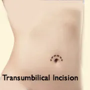 Breast augmentation transumbilical incision location