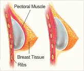 Breast implant placement under and over pectoral muscle