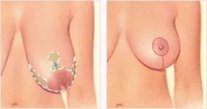 Breast lift anchor shaped incision