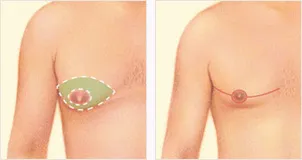 Male breast reduction incision locations