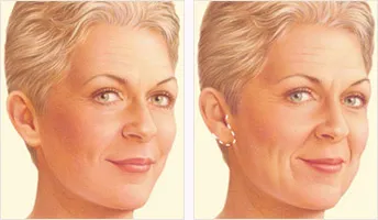 Limited facelift before and after with incision location
