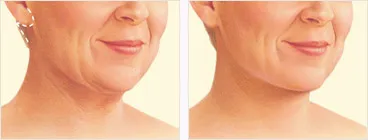 Neck lift incision before and after with incision location