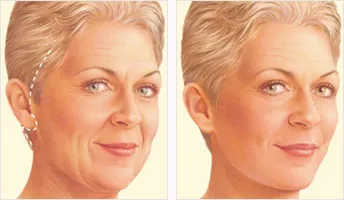 Traditional facelift before and after with incision location