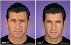 Botox male patient before and after 2