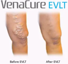 Varicose vein laser before and after