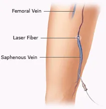 Diagram of EVLT vein treatment