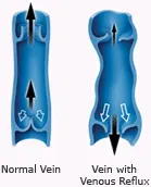 Diagram of normal vein and vein with venous reflux