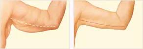 Arm lift before and after with incision location