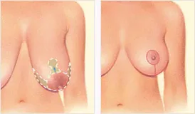 Breast lift before and after with incision locations