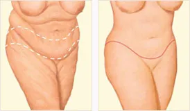 Body lift before and after with incision locations