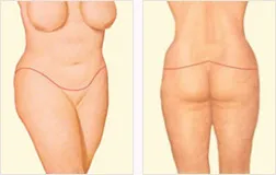 Lower body lift after with incision locations
