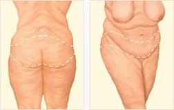 Lower body lift before with incision locations