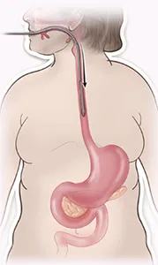 Gastric balloon placement diagram step 1