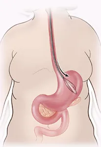 Gastric balloon placement diagram step 2