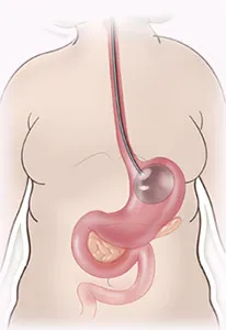 Gastric balloon placement diagram step 3