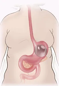 Gastric balloon removal diagram step 1