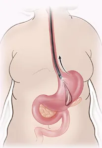 Gastric balloon removal diagram step 2