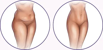 Liposuction before and after abdomen and thighs