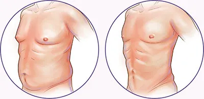 Liposuction before and after chest and abdomen