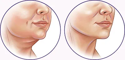Liposuction before and after face and neck