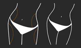 Diagram of body areas treated by Smartlipo