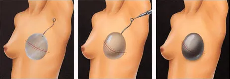 Breast expander