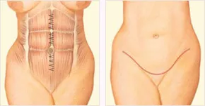 Diagram showing abdominal muscles repair and tummy tuck incision