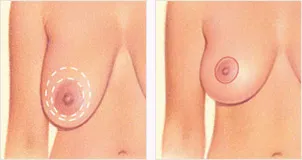 Breast lift areola incision
