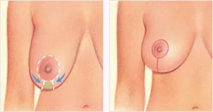 Breast lift vertical incision