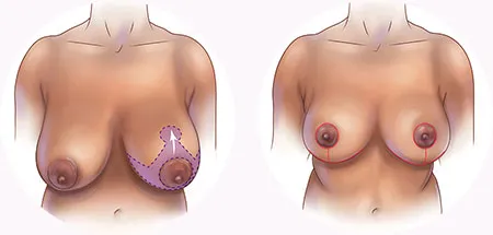 Breast reduction keyhole incision locations