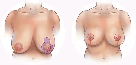 Breast reduction areola incision locations
