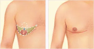 Male Breast Reduction liposuction and excision incisions diagram