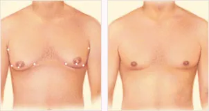 Male Breast Reduction liposuction incisions diagram
