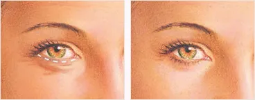 Lower eyelid surgery before and after with incision