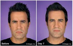 Botox male patient before and after 1