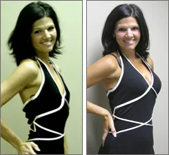Dana Littleton breast augmentation before and after