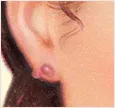 Ear with keloid scar